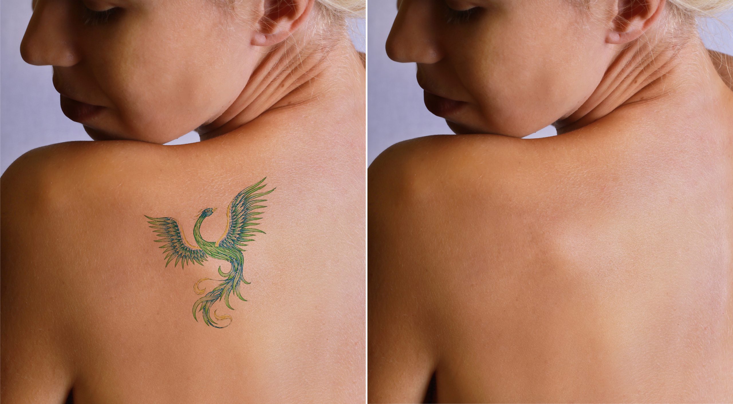 5 Signs That Tell You That it’s Time to Get a Tattoo Removed